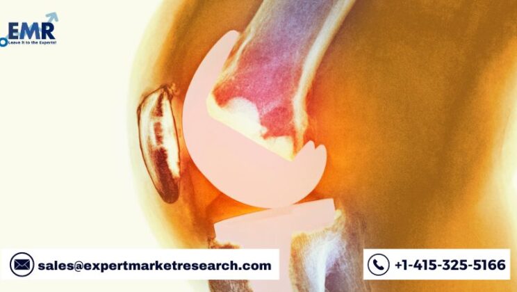 Global Cementless Total Knee Arthroplasty Market to be Driven by the Increasing Cases of Young Patients Seeking Knee Arthroplasty in the Forecast Period of 2022-2027